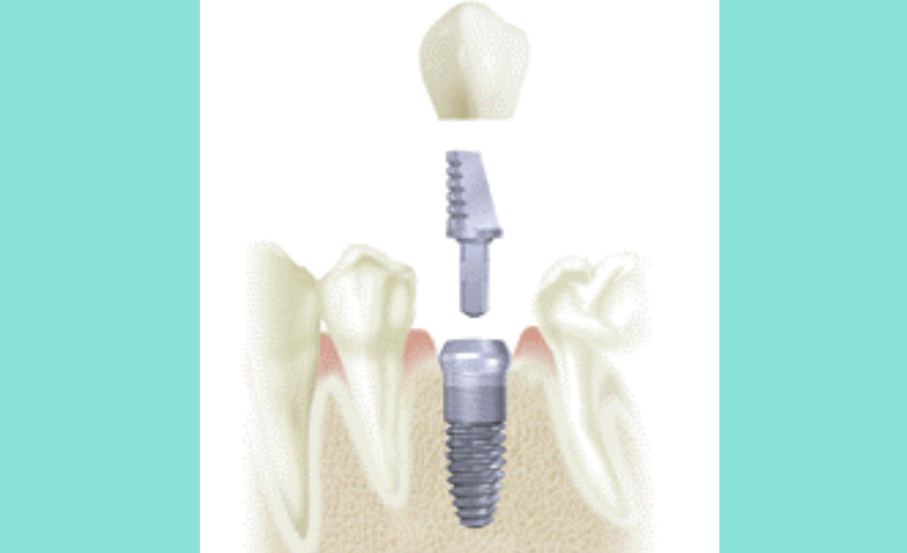 maximum time between bone graft and dental implant