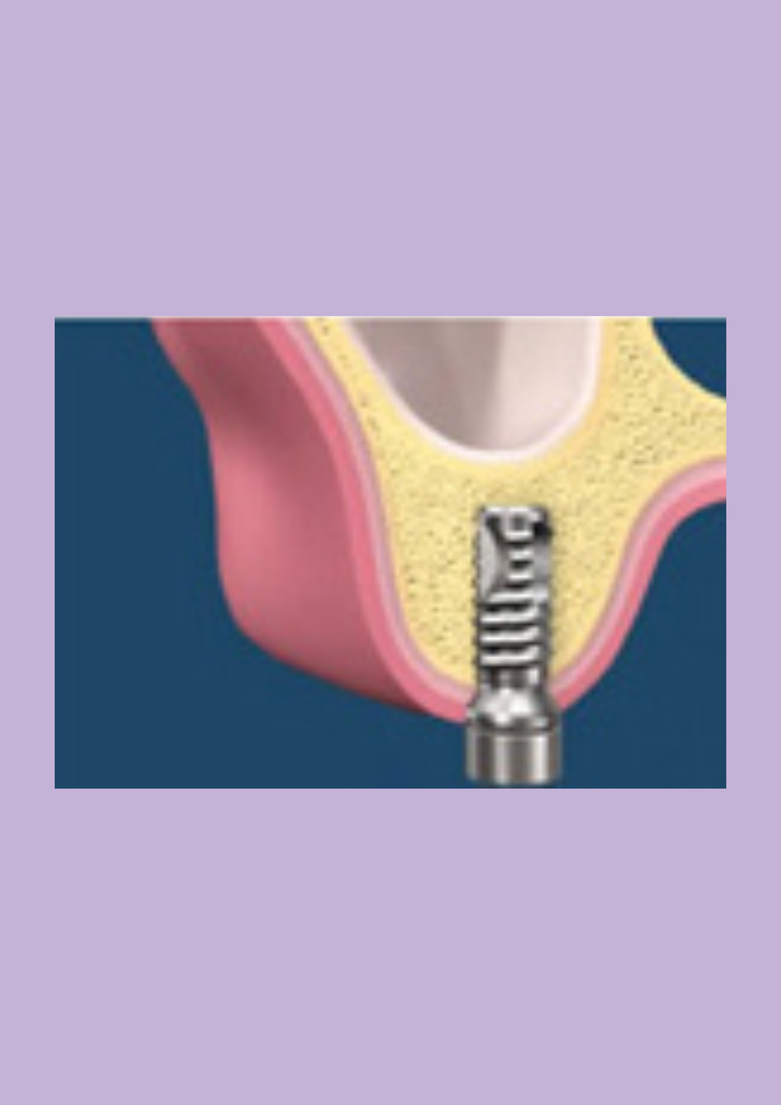 sinus lift with implant